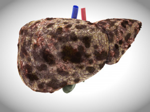 Hepatocellular Carcinoma Liver 3D 模型