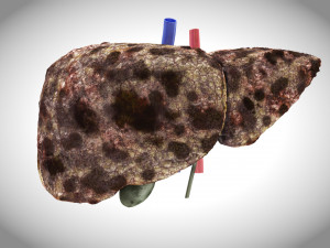 Hepatocellular Carcinoma Liver Modelo 3D