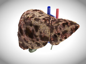 Hepatocellular Carcinoma Liver Modelo 3D