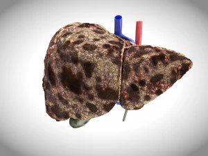 Hepatocellular Carcinoma Liver 3D Model