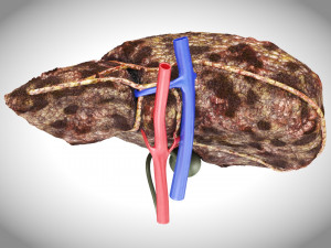 Hepatocellular Carcinoma Liver Modelo 3D