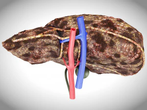 Hepatocellular Carcinoma Liver 3D Model