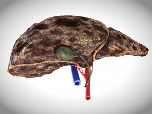 Hepatocellular Carcinoma Liver 3D Model