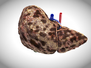 Hepatocellular Carcinoma Liver Modelo 3D