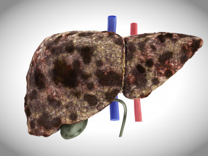 Hepatocellular Carcinoma Liver Modelo 3D