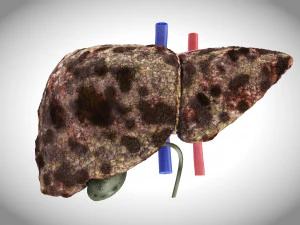 Hepatocellular Carcinoma Liver 3D Model