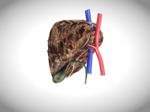 Hepatocellular Carcinoma Liver Modelo 3D
