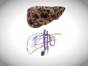 Hepatocellular Carcinoma Liver 3D Model