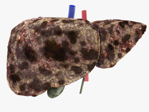 Hepatocellular Carcinoma Liver Modelo 3D