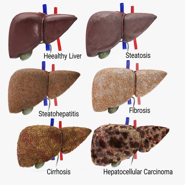Liver Diseases Collection 3D-Modell .c4d .max .obj .3ds .fbx .stl .blend 