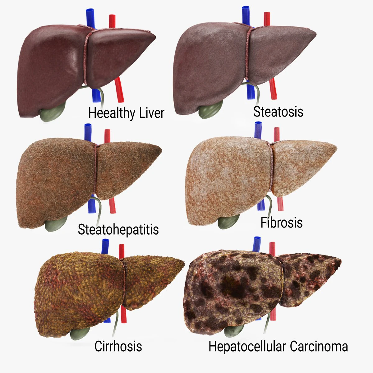 Liver Diseases Collection 3D Model .c4d .max .obj .3ds .fbx .stl .blend