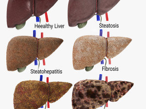 Liver Diseases Collection 3D 模型