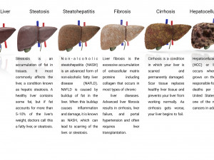 Liver Diseases Collection 3D-Modell
