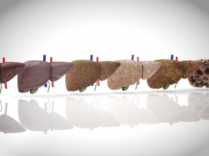 Liver Diseases Collection 3D-Modell