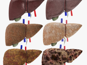Liver Diseases Collection 3D-Modell