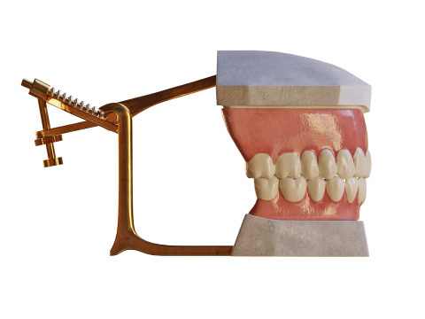 Dental Prosthesis 3D Model