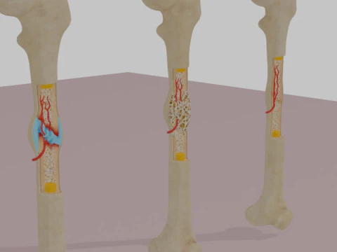 Human Long Bone Structure Internal Anatomy and Healing stages 3D Model
