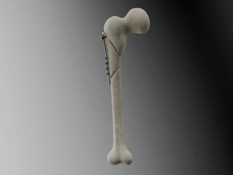 Fraktur Femur dengan Pelat Fiksasi dan Sekrup Model 3D